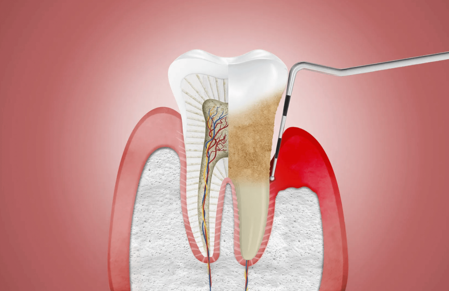 Periodontal Therapy – Valleyview Dental